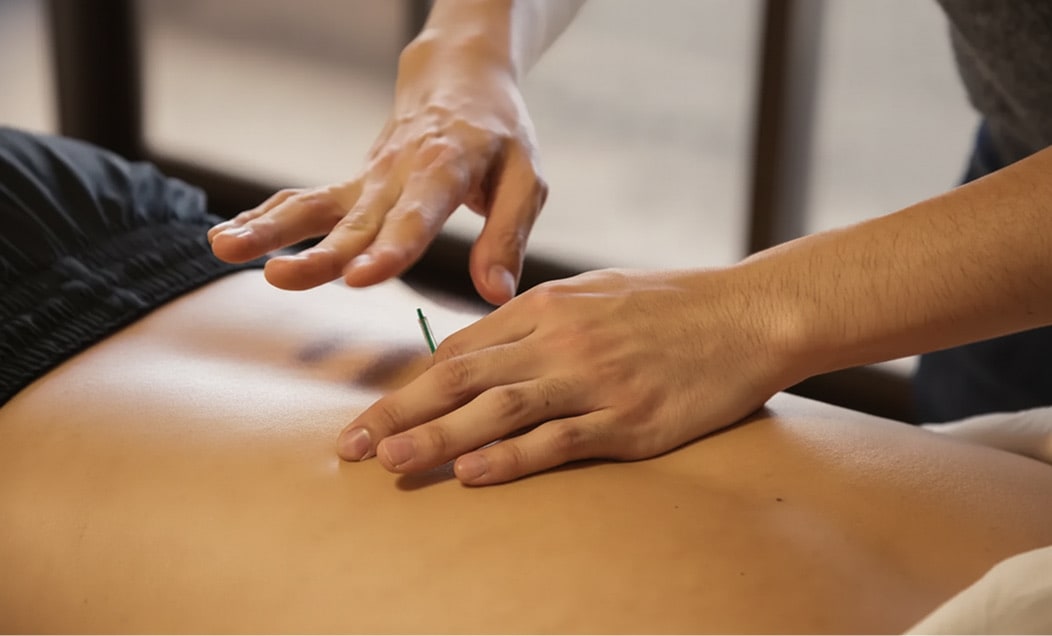 Distal acupuncture - practitioner placing needle on patient's back